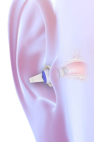 Alpine SleepDeep in the ear